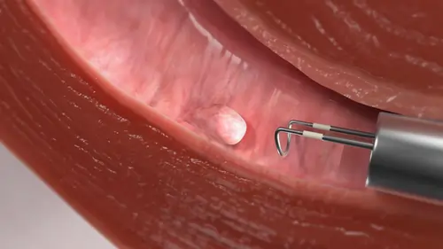 laparoscopy-hysteroscopy-in-lucknow